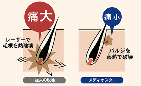 ゴリラクリニック 蓄熱式の医療レーザー脱毛機